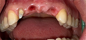 fogimplantátumos fogpótlás Dent Art Klinik fogászati rendelő Győr