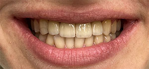 fogimplantátumos fogpótlás Dent Art Klinik fogászati rendelő Győr