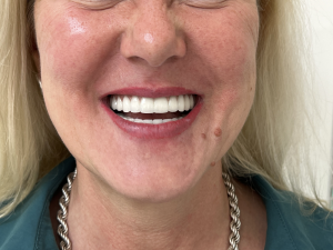 Andrea bemutatja az új fogimplantátumot közelről. Gyönyörűen mosolyog újra. Mennyi a fogimplantátumok gyógyulási ideje? A korábbi rendelő hibája miatt másfél évbe telt, de Andrea újra tökéletes!